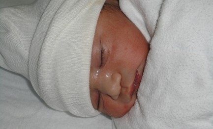 IVF new born baby